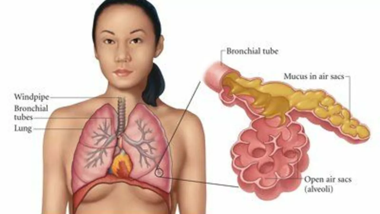 Pneumonia and Stress: How They're Connected