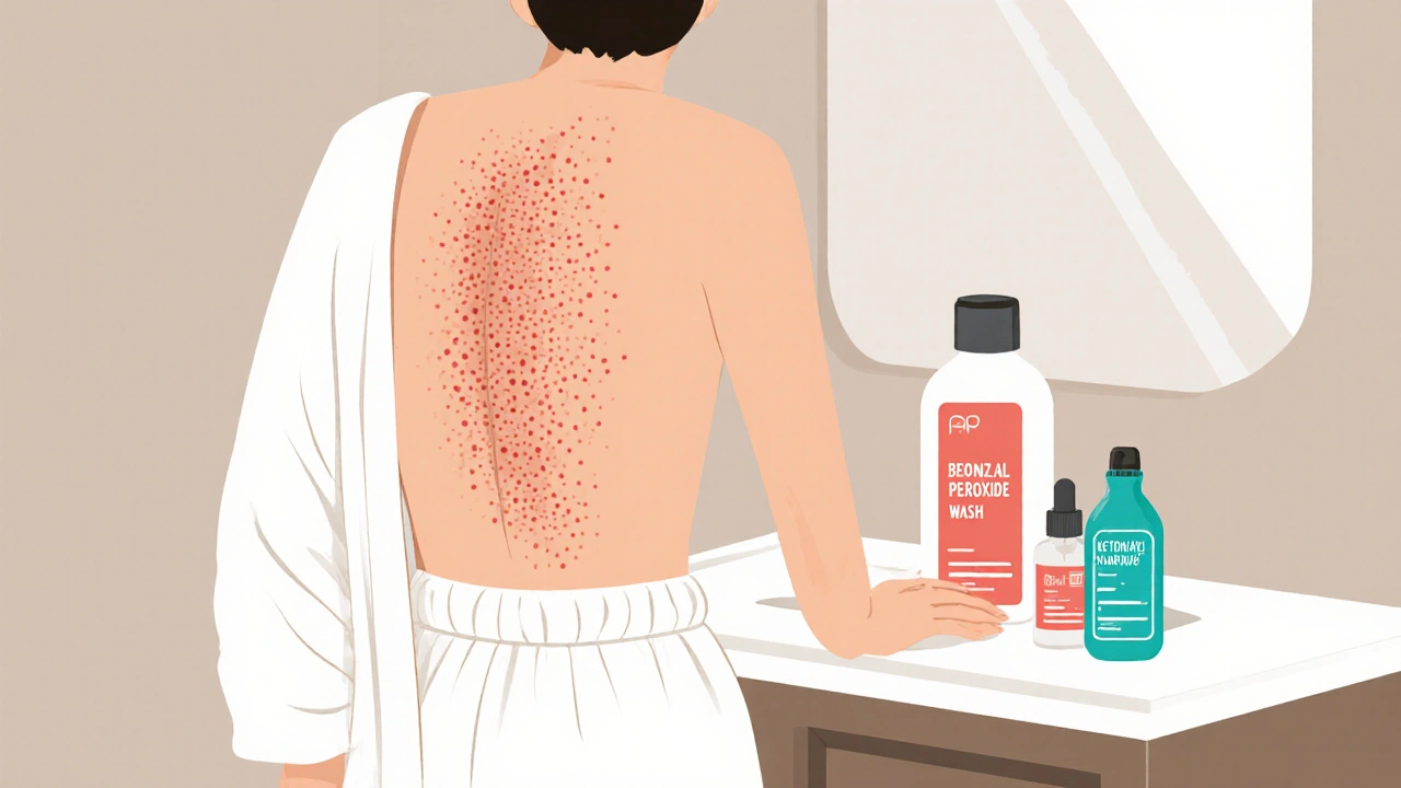 Steroid-Induced Acne and Skin Changes: Topical and Lifestyle Solutions